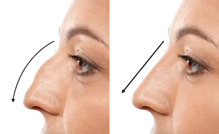 Rhinoplastik: Nasenkorrektur und Profilanalyse
