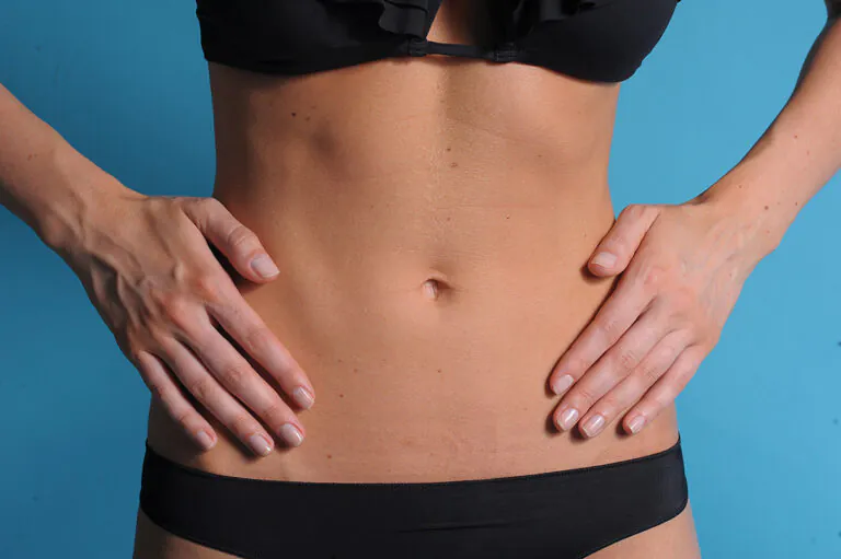 Abdominoplastik 3