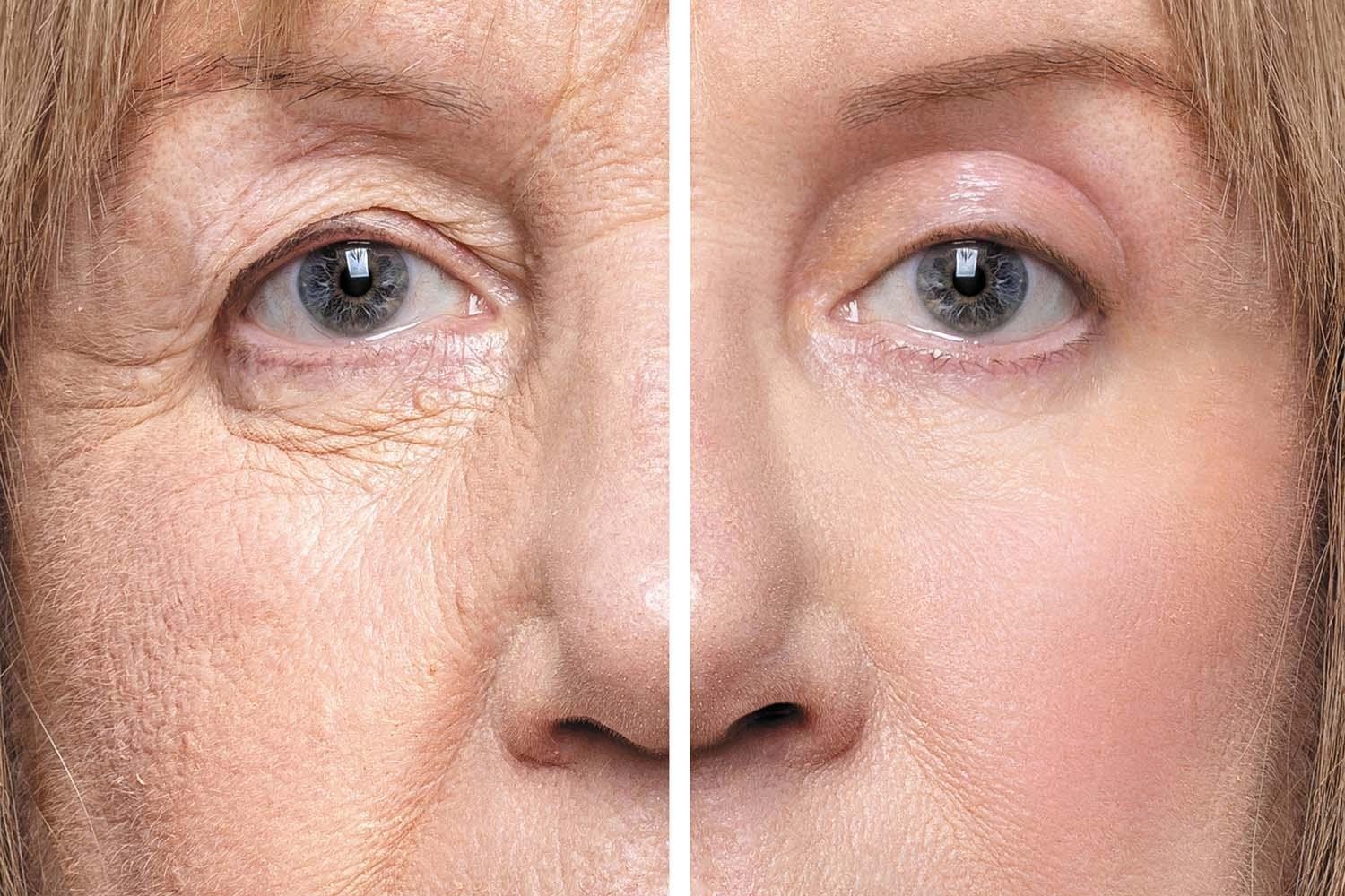 Blepharoplastik — Ober- und Unterlid