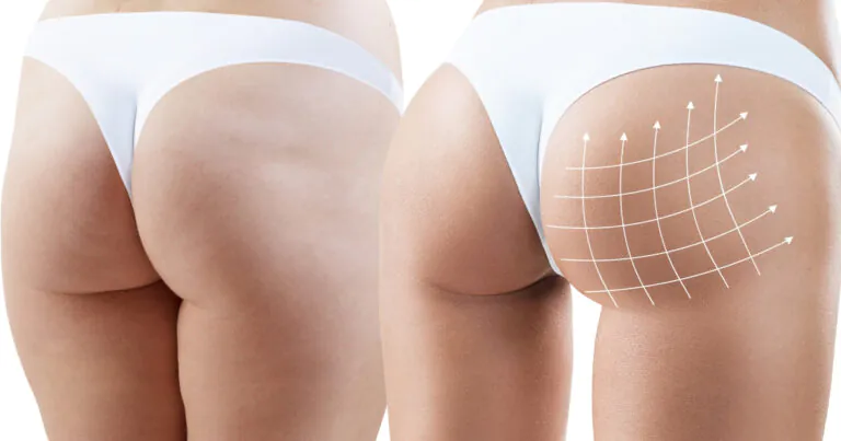 Gluteoplastik Kontur vor und nach Behandlung