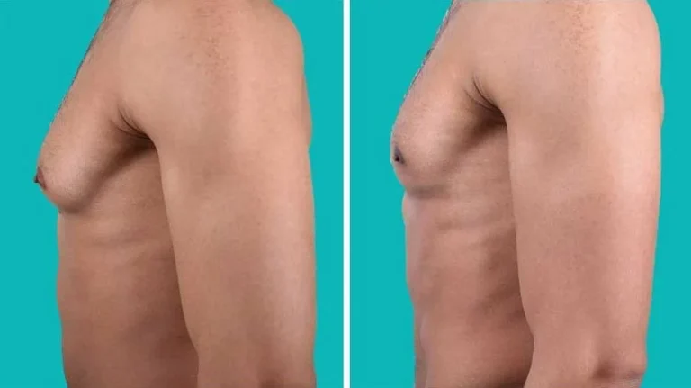 Gynäkomastie Profil vor und nach Behandlung