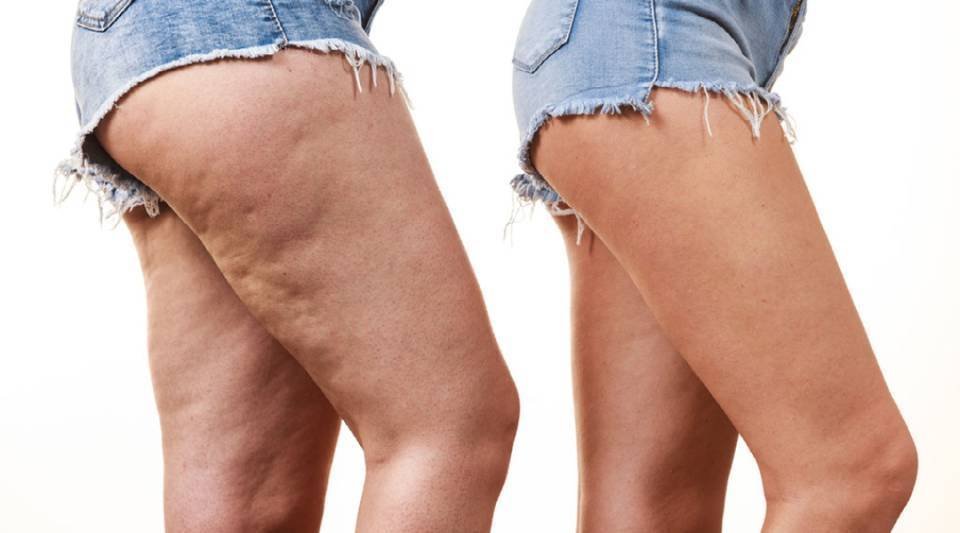 Lipödem – Extremitätenkontur nach Behandlung